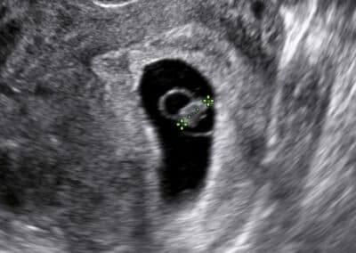 Vyšetření časného těhotenství