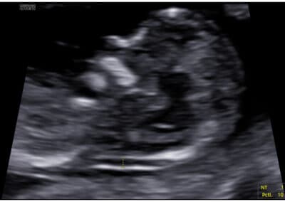 NT screening Downova syndormu v 1. trimestru