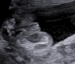 Určení pohlaví miminka