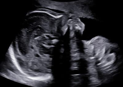 Screening vrozených vad ve 2. trimestru