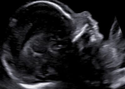 Genetický ultrazvuk