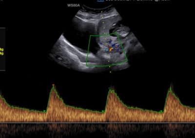 Screening preeklampsie a zaostávání růstu miminka