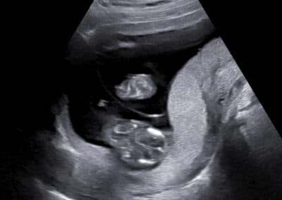 Vyšetření vícečetných těhotenství