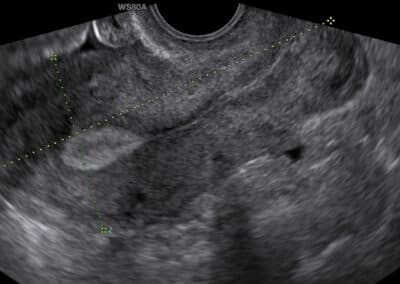 Ultrazvukové vyšetření ženských orgánů